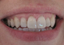 invisalign-caso-a- dopo