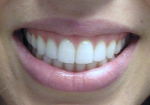 invisalign-caso-b-dopo