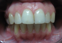 invisalign-caso-b-prima