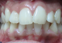 invisalign-caso-c-prima