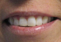 invisalign-caso-d-dopo