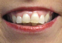 invisalign-caso-d-prima